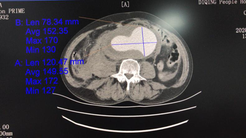 腹主动脉瘤破裂情况ct影像资料